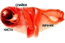 Лапароскопія кісти яєчника підготовка та проведення кісти
