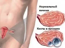 Лапароскопія кісти яєчника підготовка та проведення кісти