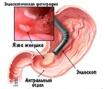 Виразкова хвороба, її види, діагностика, лікування виразкова
