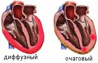 Міокардит - причини, симптоми, діагностика та лікування причини