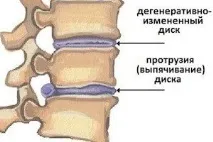 Чи можна витягувати хребет при протрузії його
