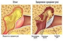 капки