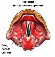 Гострий та хронічний ларингіт - симптоми, лікування гортані