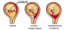 плаценти
