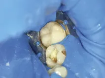 Техніка нанесення великих шарів Bulk Fill -Dental Magazine шарів