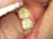 Техніка нанесення великих шарів Bulk Fill -Dental Magazine нанесення