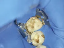 Техніка нанесення великих шарів Bulk Fill -Dental Magazine нанесення