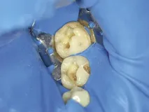 Техніка нанесення великих шарів Bulk Fill -Dental Magazine техніка