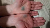 В Удмуртії на 10-річну дівчинку напав сусідський собака - Новини Іжевська та Удмуртії, новини напав