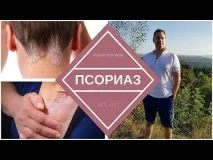 Все про псоріаз – симптоматика та способилікування симптоматика