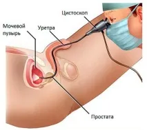 Що таке колікуліт причини, форми, симптоми, діагностика, принципи лікування причини