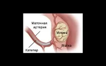 Емболізація маткових артерій – малотравматичний метод лікування міоми матки маткових