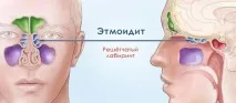 Етмоїдит - симптоми та лікування у дорослих запалення ґратчастої пазухи симптоми