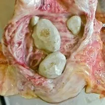 Калькульозний (кам’яний) простатит та його лікування калькульозний