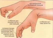 Контрактура суглобів - види, причини, симптоми та лікування лікування
