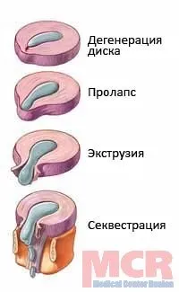 междупрешленния