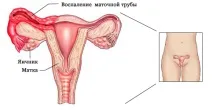 Лікування аднекситу аднекситу