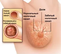 Лактостаз у матері-годувальниці основні ознаки та ефективні способи лікування матері-годувальниці