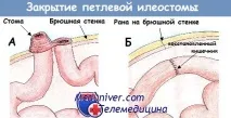 Методика закриття ілеостоми ілеостоми