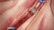 Московські хірурги врятували німецького туриста від інсульту туриста