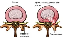 Чому німіють ноги і чому німіють пальці на ногах пальці