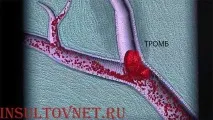 Симптоми мікроінсульту як вчасно розпізнати напад напад