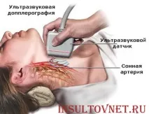 Симптоми мікроінсульту як вчасно розпізнати напад мікроінсульту