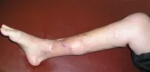 Температура при переломі ноги причини та усунення ноги