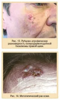 лікування