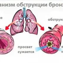 Що таке обструктивний бронхіт та як його лікувати його