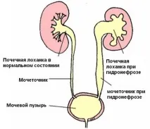 Гідронефроз правої нирки при вагітності - Здоров’я Інфо вагітності