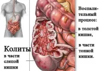 спастичний
