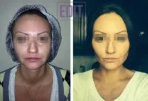 Контурна пластика обличчя - ціна ціна