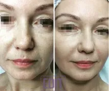 Контурна пластика обличчя - ціна ціна