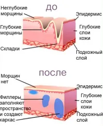Контурна пластика обличчя - ціна обличчя