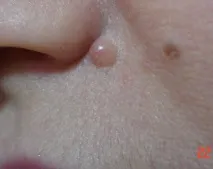 родимок