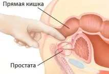 Масаж при геморої чи можна турбувати гемороїдальні вузли масаж