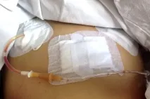 Місячні після лапароскопії кісти яєчника – коли чекати кісти
