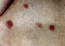 Метастази після видалення клітини