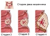 Пухлина кишечника розпадається симптоми, ознаки, діагностика та лікування пухлина