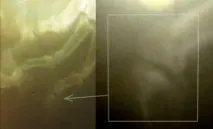 Плоскоклітинний ороговіючий рак фаланги пальця у собаки фаланги