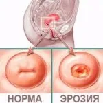 Причини та лікування ерозії шийки матки лазером матки