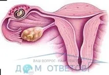 Наслідки лікування кісти яєчника - відповіді та поради на твої питання лікування