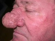симптоми