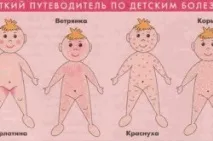Температура при вітрянці у дітей дітей