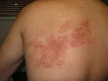 Вітрянка (вітряна віспа) вітрянка