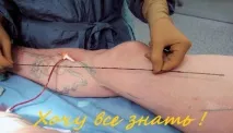 Все про варикоз вени
