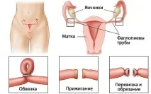 Жіноча стерилізація як метод контрацепції стерилізація