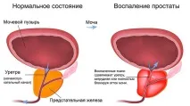 Який лікар лікує простатити у чоловіків лікує