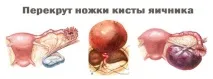 менопаузі